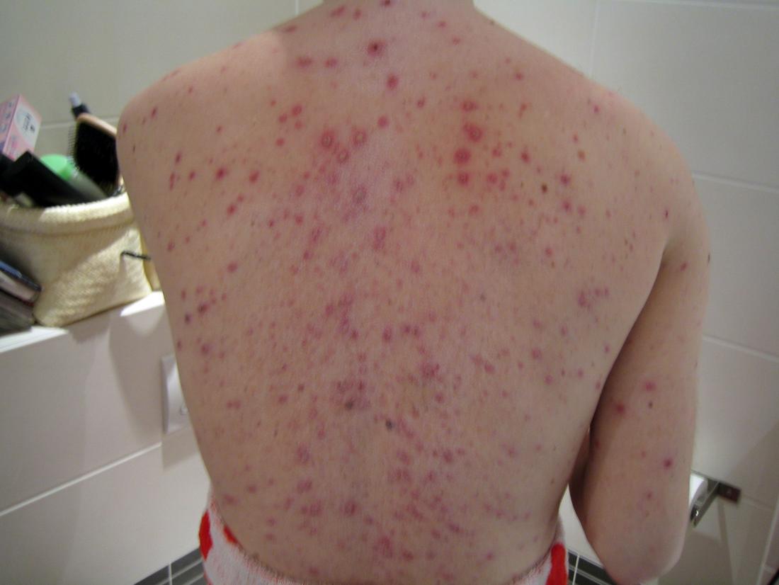 chickenpox in adults