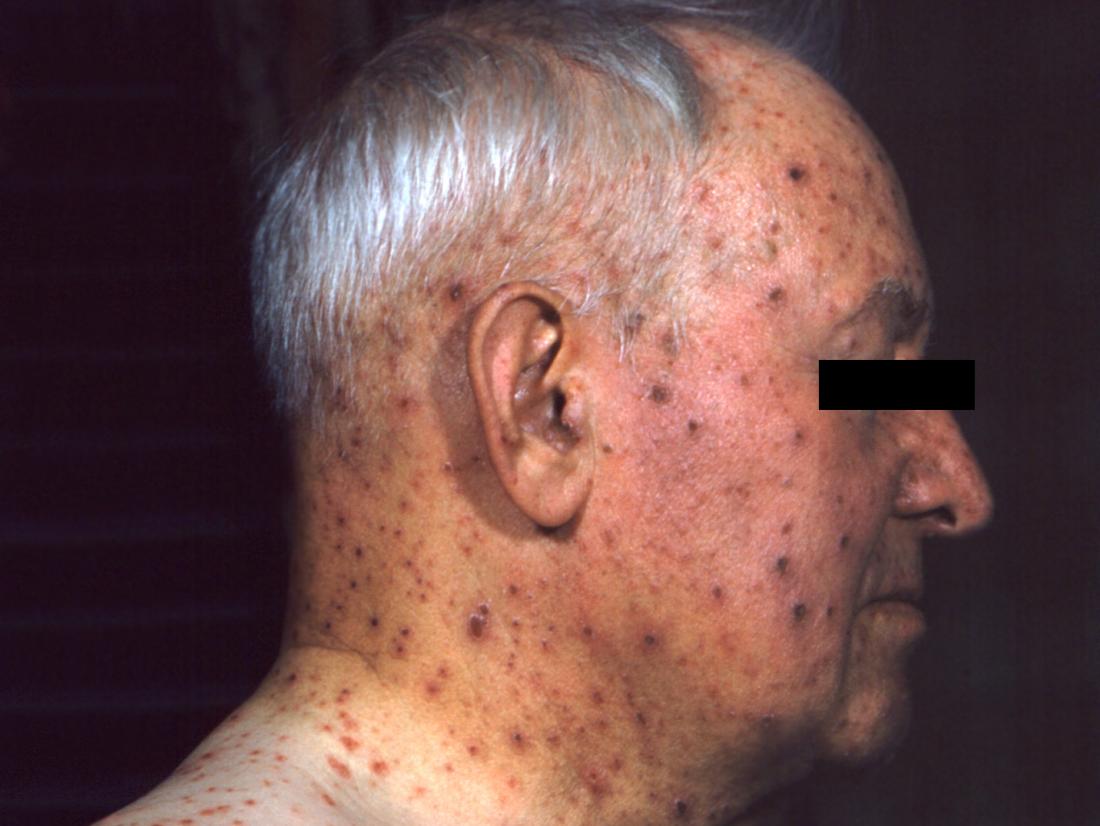 chicken pox pictures in adults