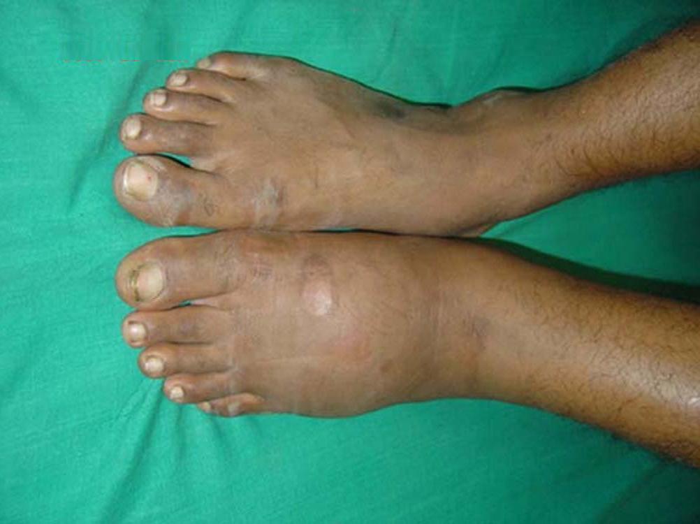 feet with Charcot arthropathy. Image credit: J. Terrence Jose Jerome, 2008