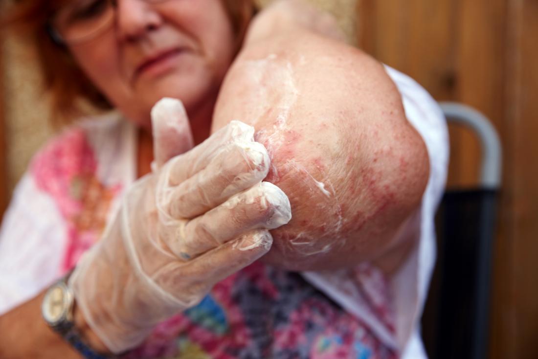 a woman with bumps on the elbow from Eczema