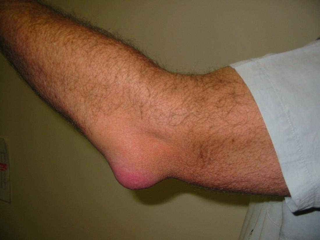 Bursitus of the elbow. Image credit: PD, 2007