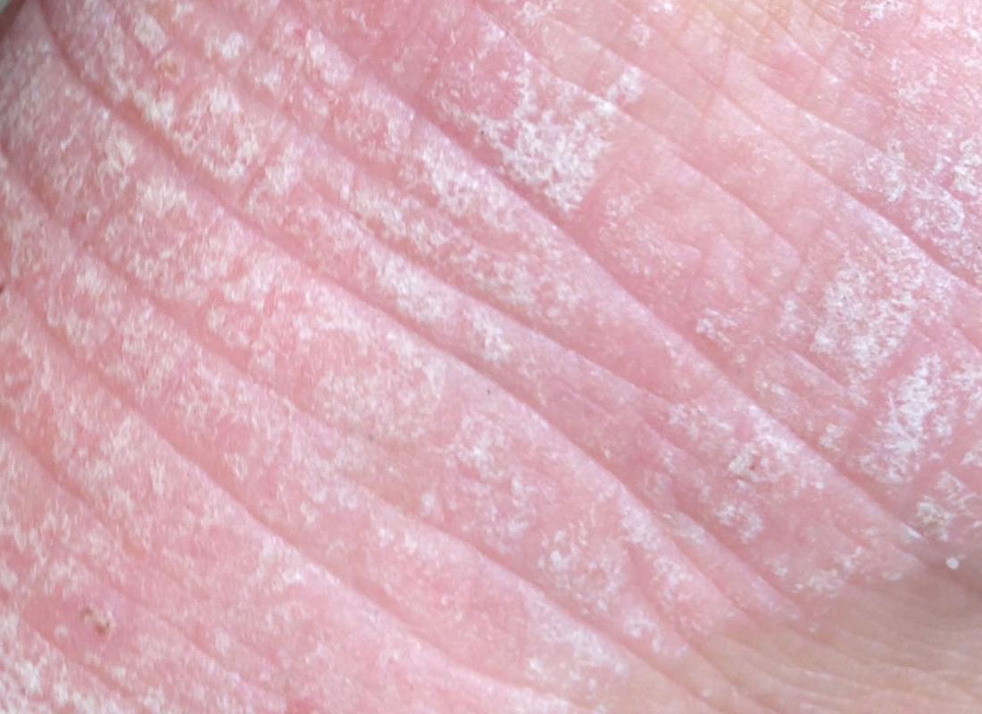 dermatitis herpetiformis on foot image credit ballenablanca 2013