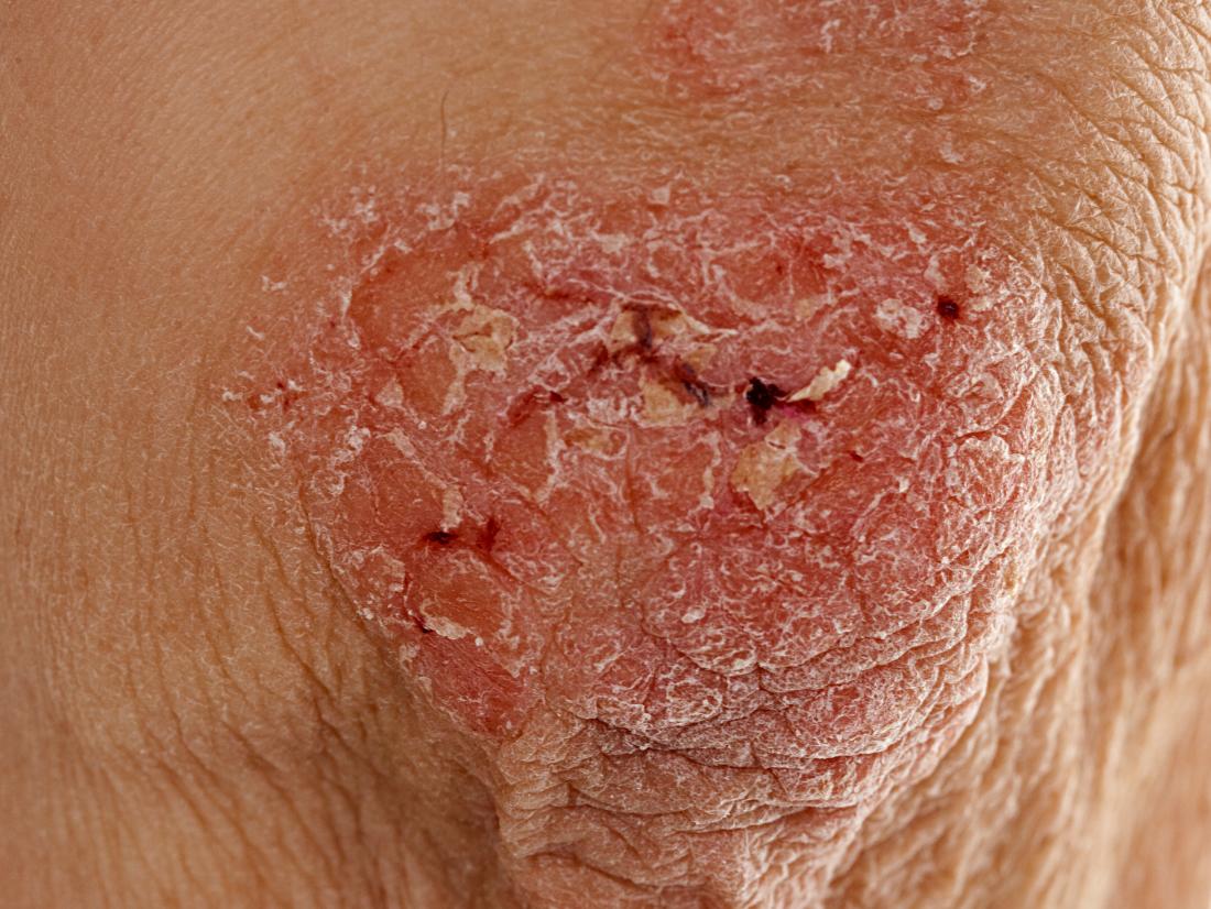 Dermatitis Herpetiformis Armpit