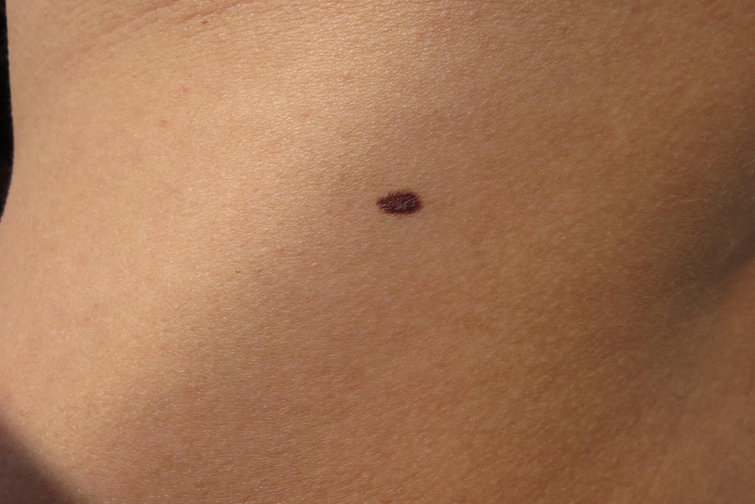 skin moles to worry about