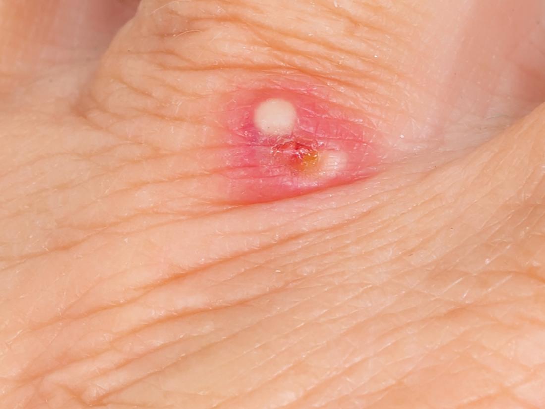 Pimple On The Hand Causes And Treatment