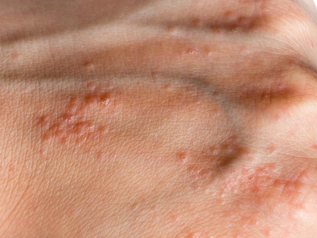 what-causes-small-bumps-on-hands-that-itch-allergy-trigger