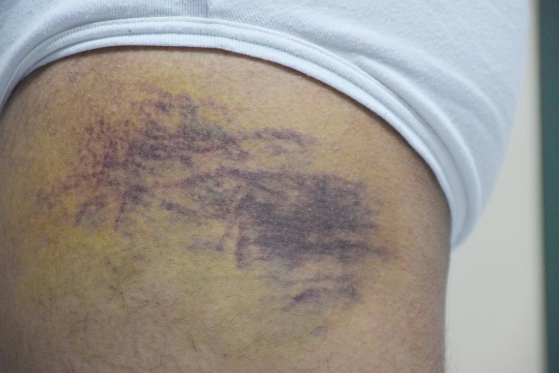 Bruises on dark skin: and treatment
