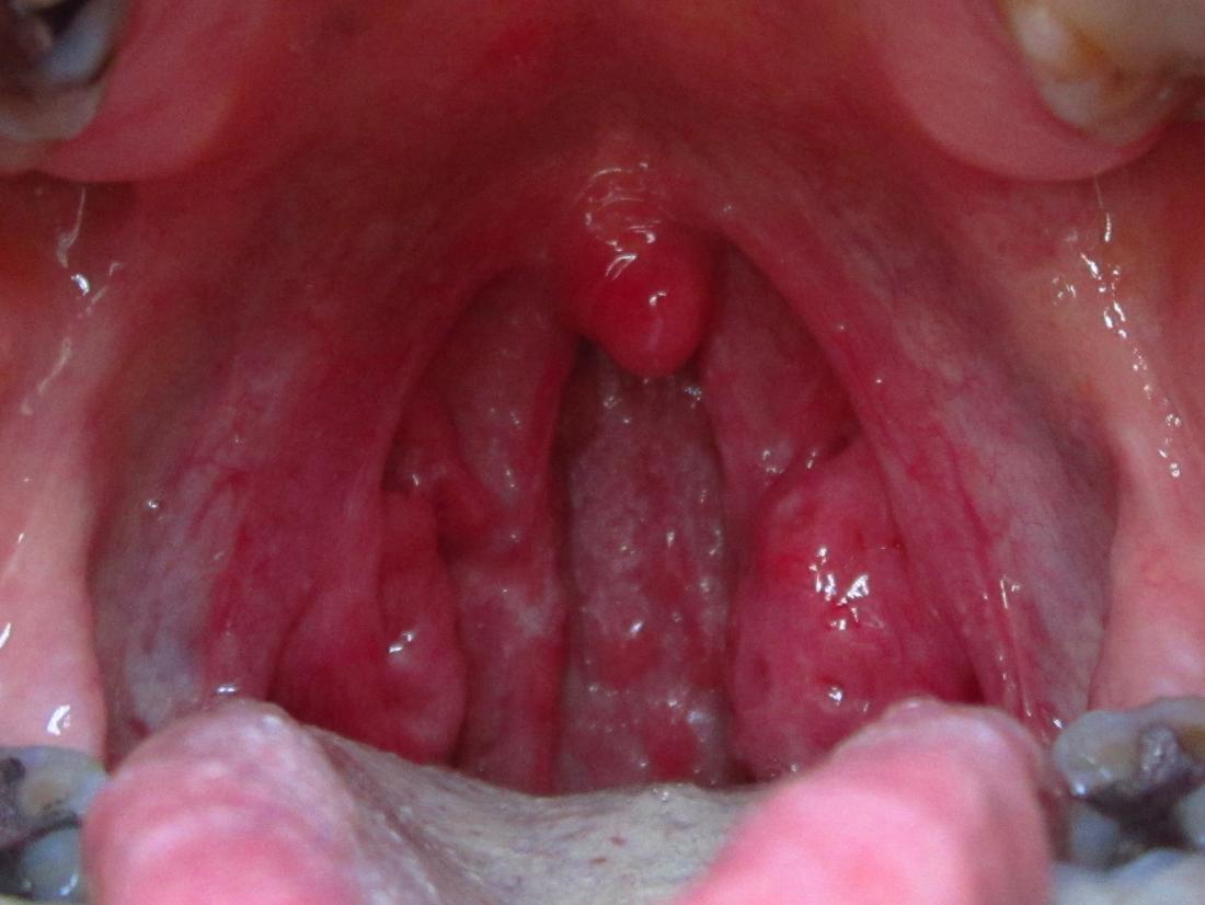 normal throat bumps