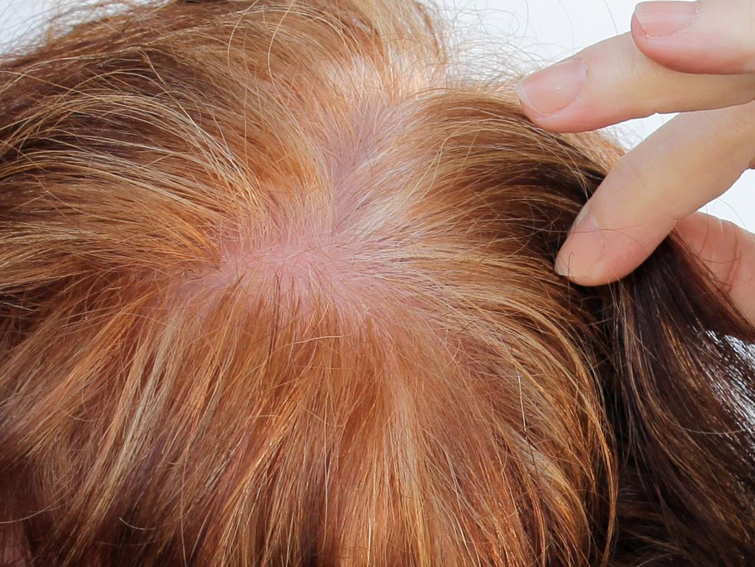 hair loss in a woman who could use PRP