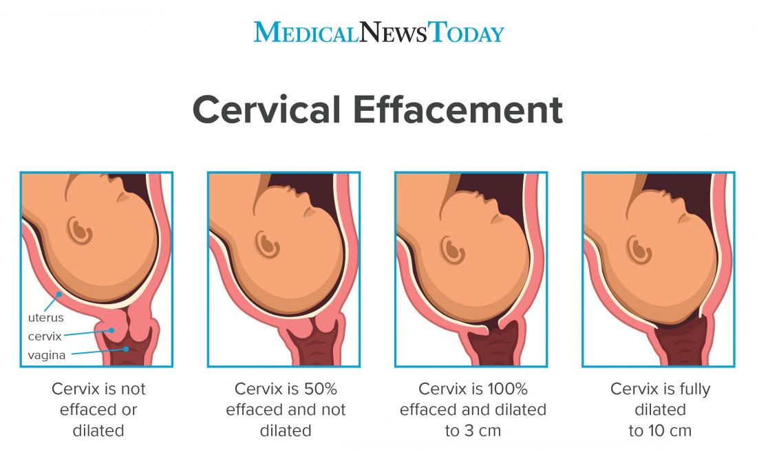 What to know about cervical effacement Measurements and diagram