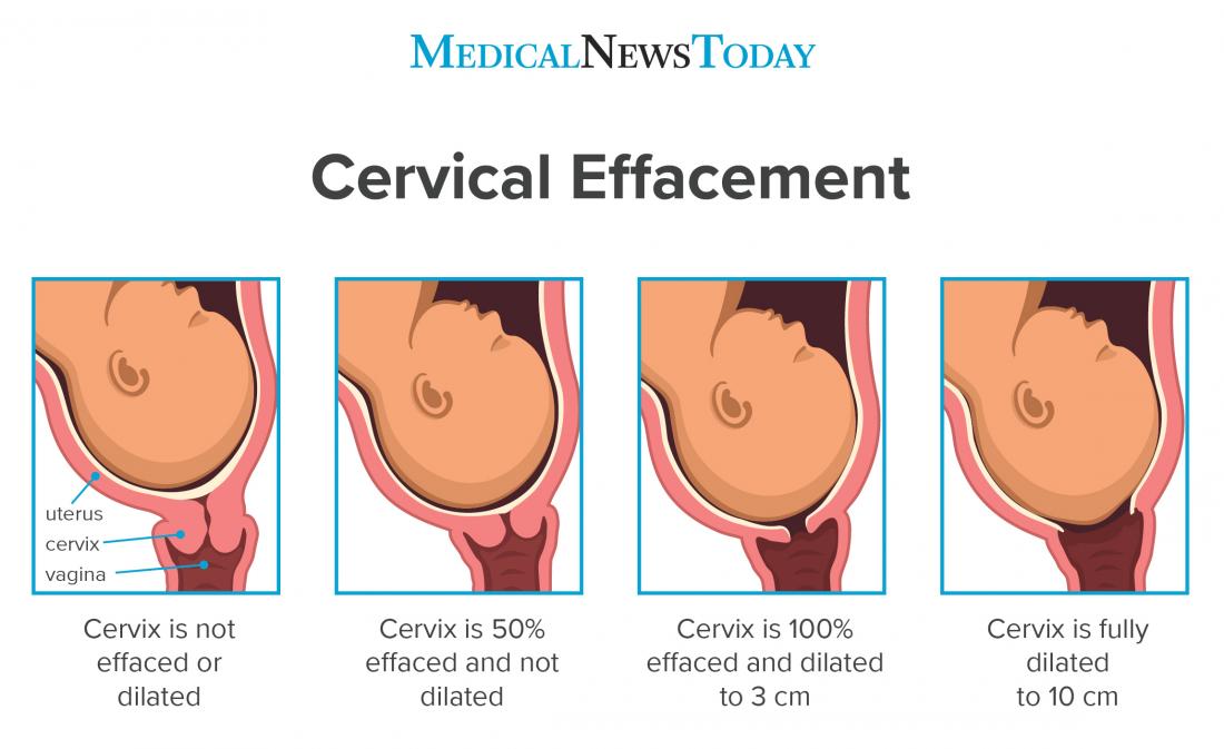 Cervical Effacement Dilation Cervical Effacement Cervical 40 OFF
