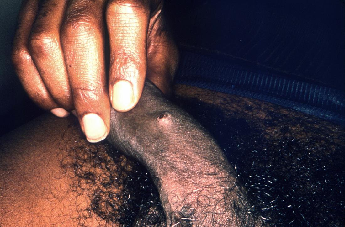 Cysts on penile shaft from masturbation