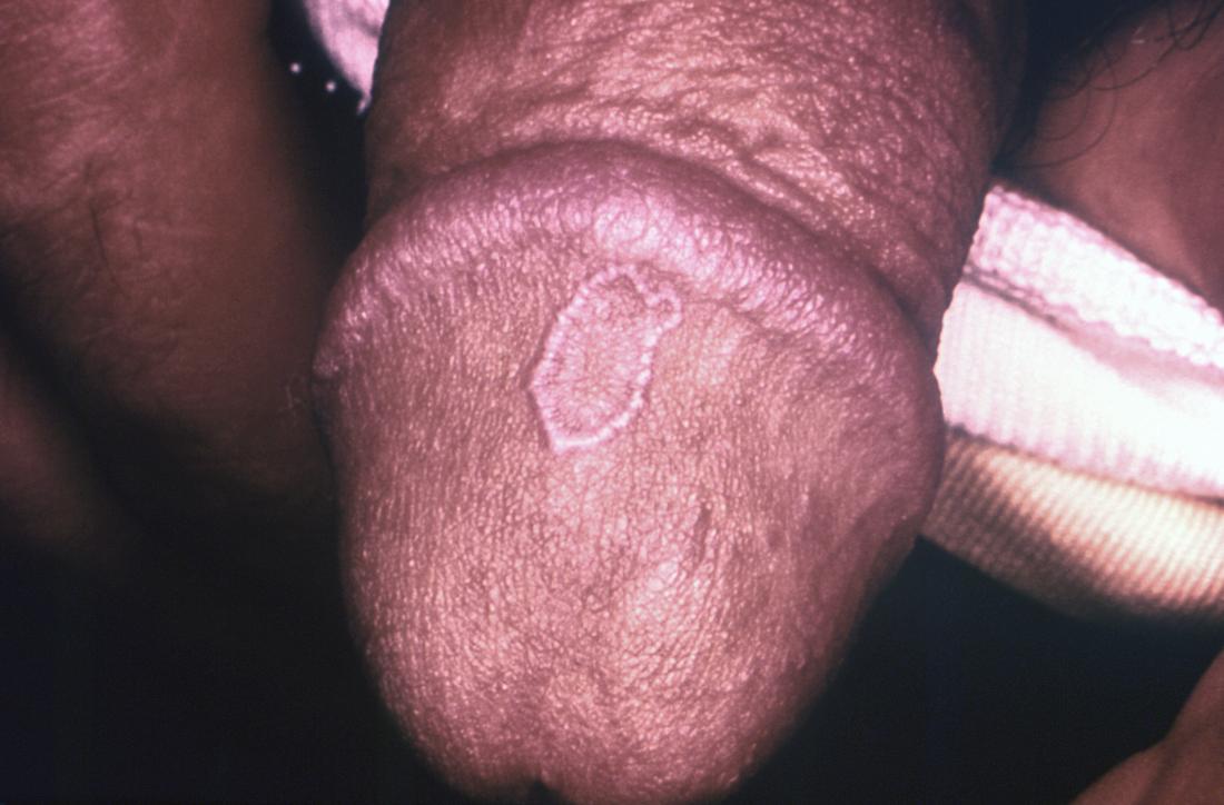 Lump on penis