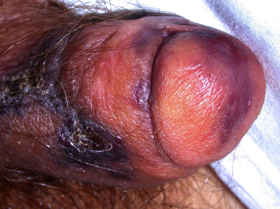 penile cancer br image credit dermnet new zealand br
