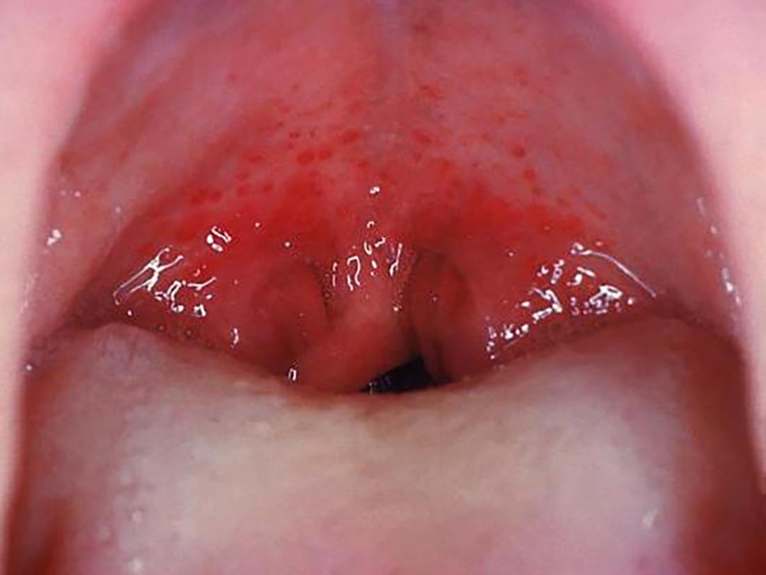 strep throat infection br image credit cdc dr heinz f eichenwald 1958 br