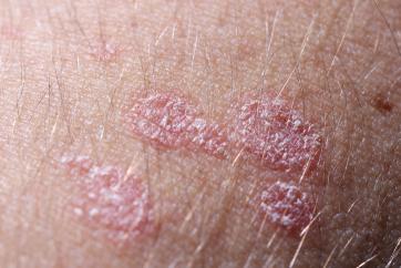 guttate psoriasis