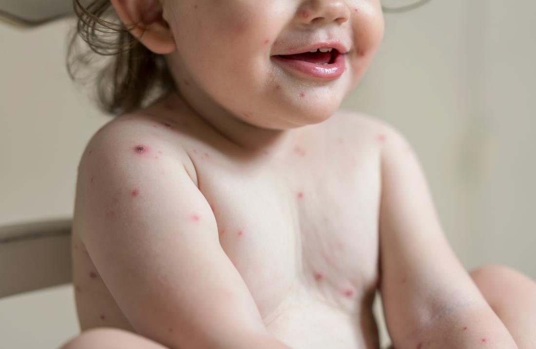 Chickenpox in babies: Pictures, symptoms, and treatments