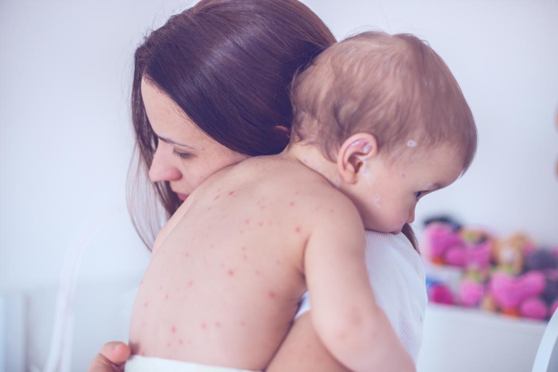a mother holding her baby who has chickenpox.