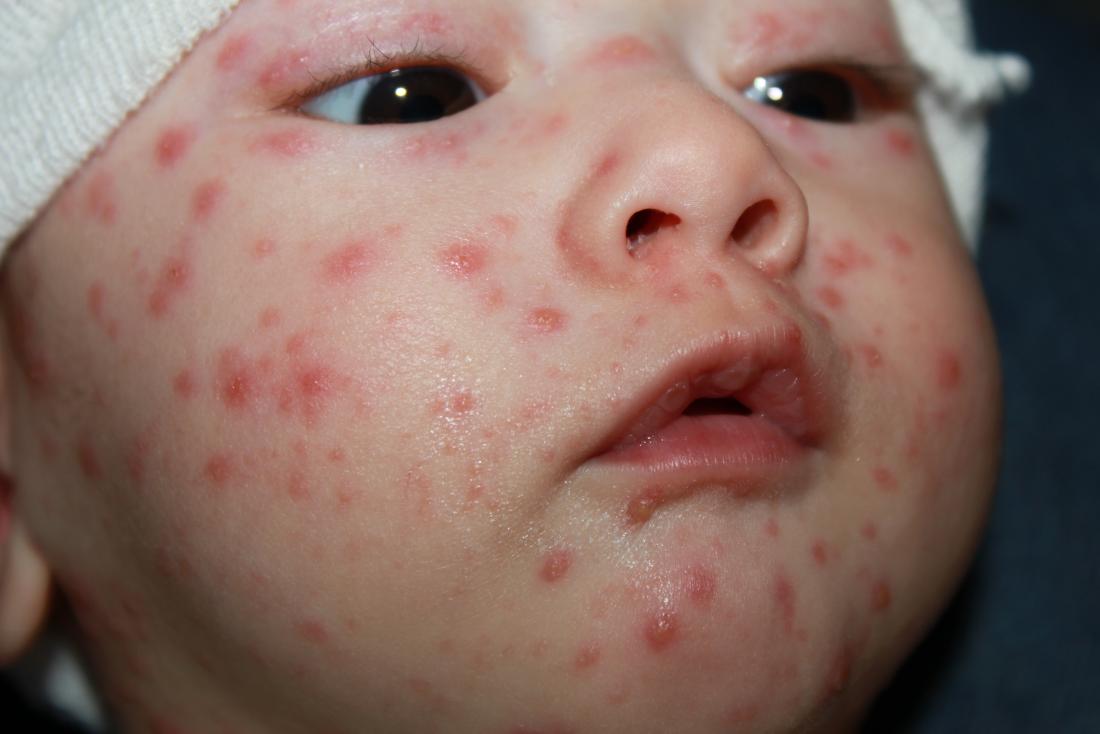 chicken pox on babies