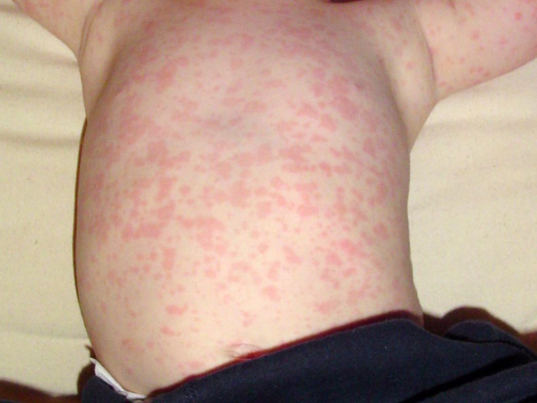 Skin Rashes in Children: Symptoms, Causes & Treatment