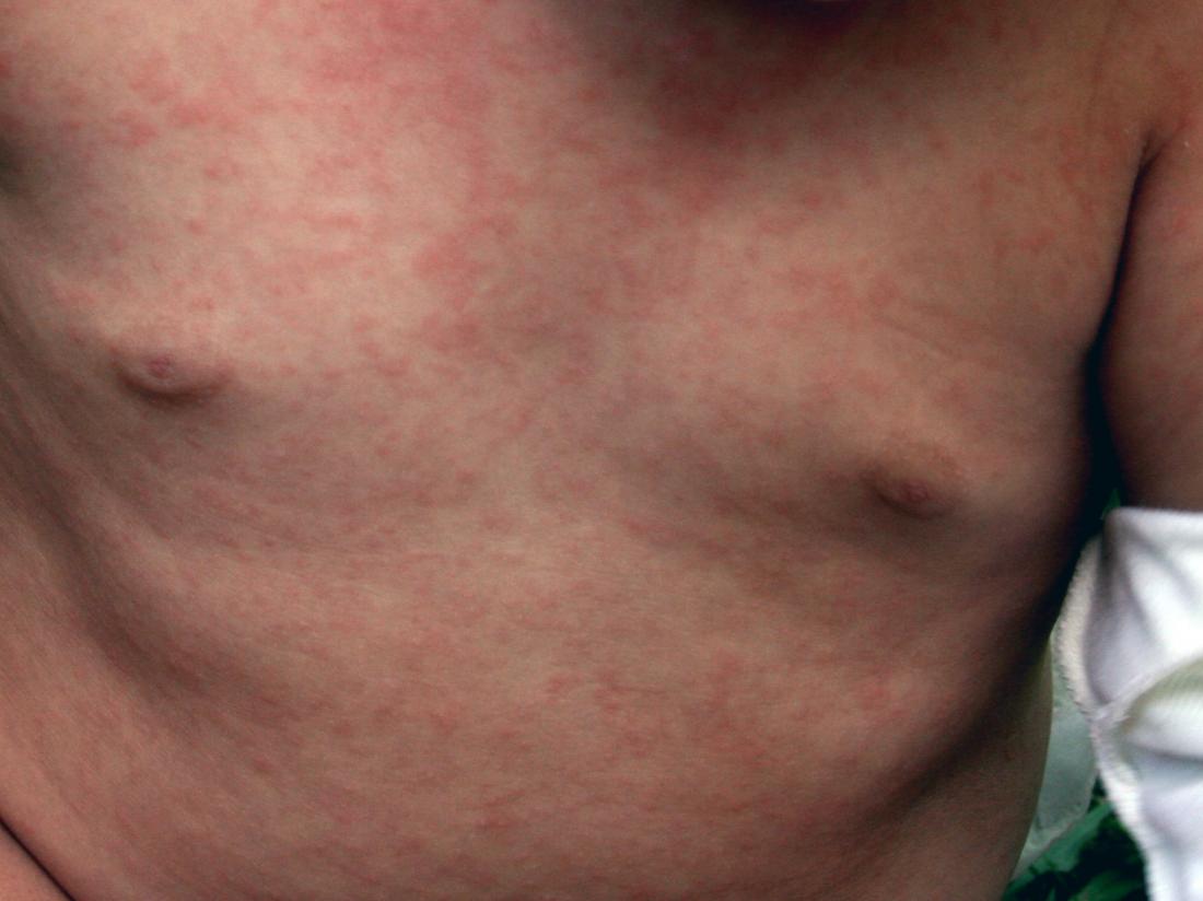 what-to-know-about-viral-rash-in-adults-and-babies-baby-recent