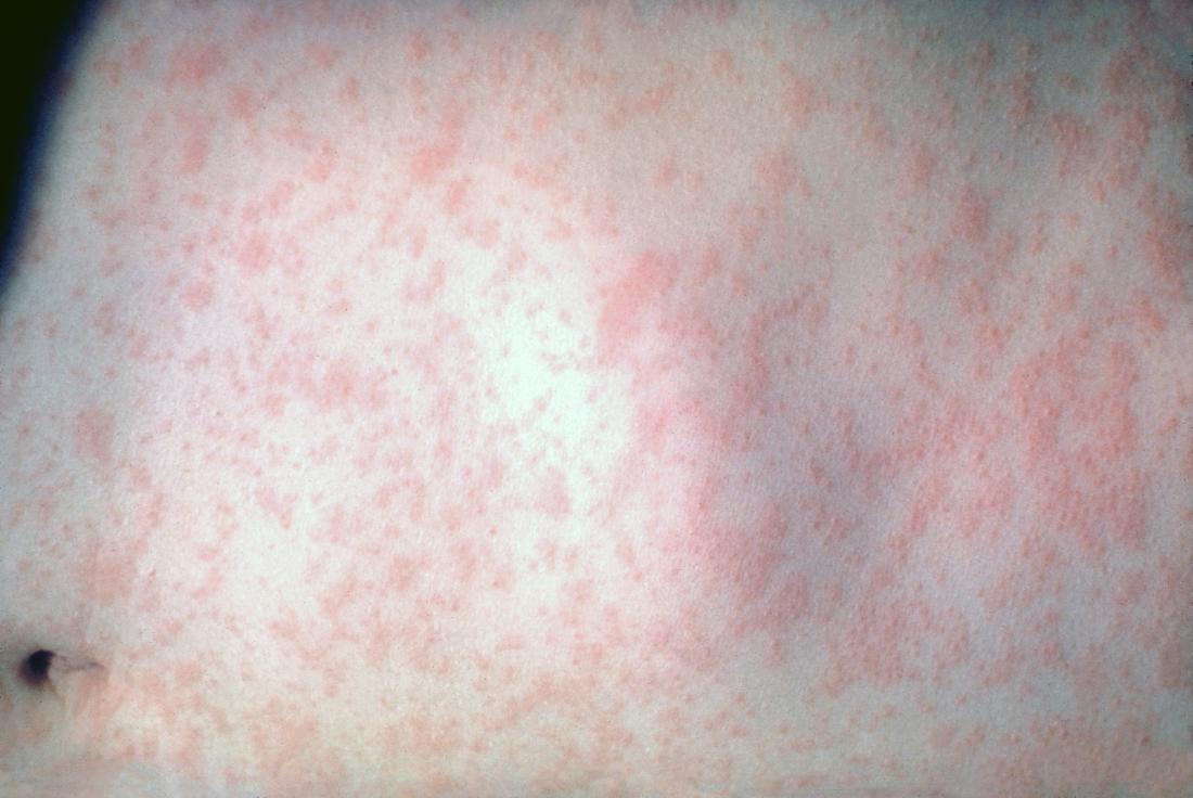 Morbillivirus measles infection creating rash on skin. Image credit: CDC/Dr. Heinz F. Eichenwald, 1958