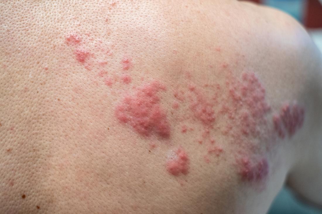stages of shingles rash