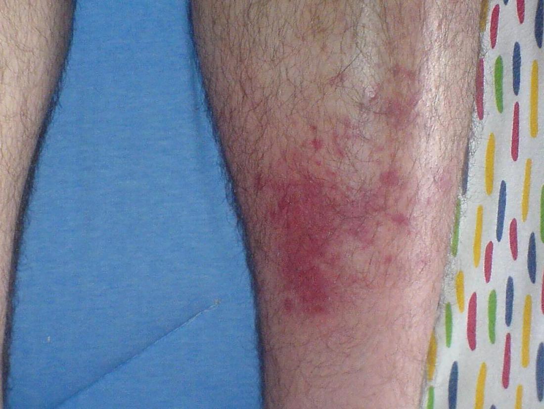 Cellulitis From Bug Bites Signs Symptoms And Treatment