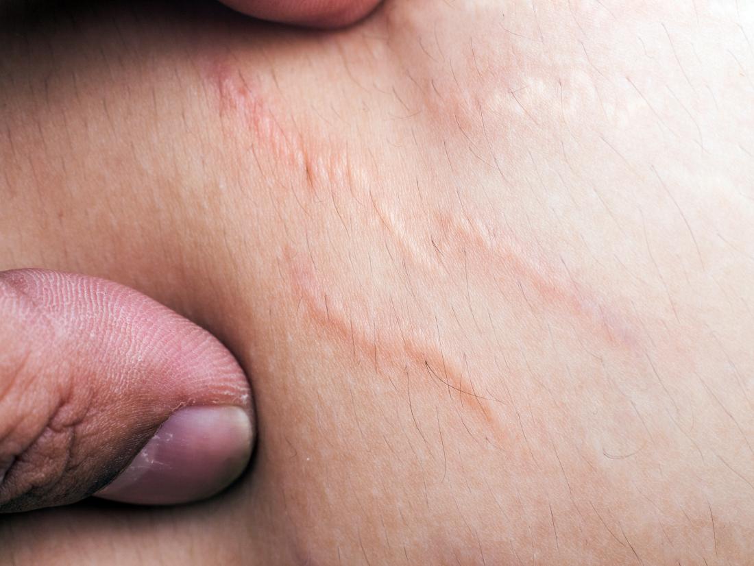 pock marks on skin