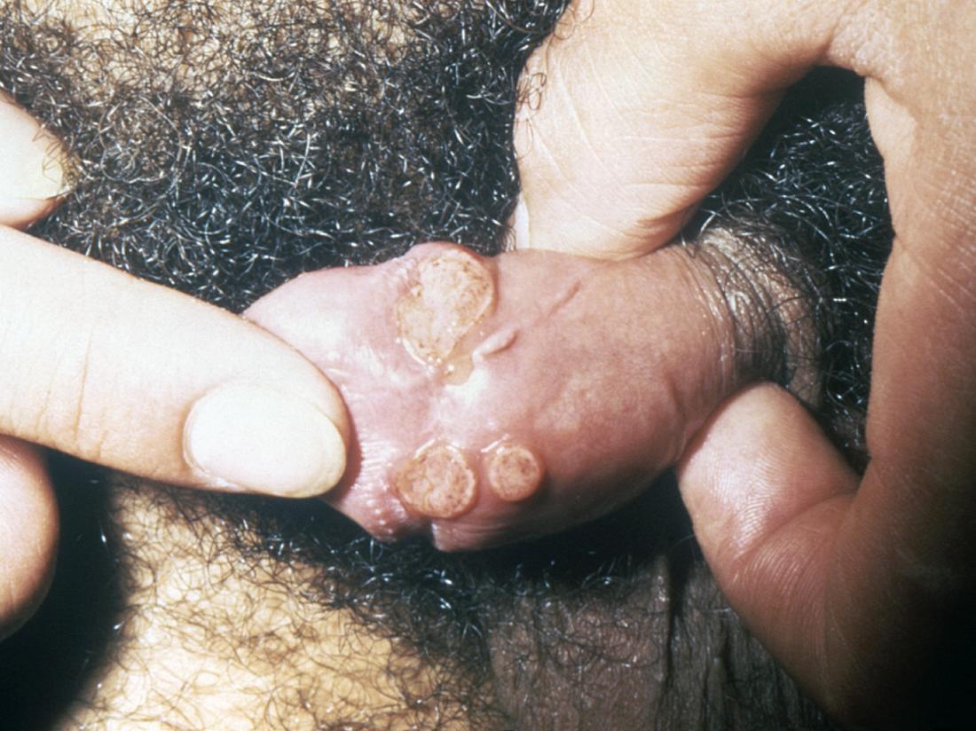 Penis sores 12 causes and treatments