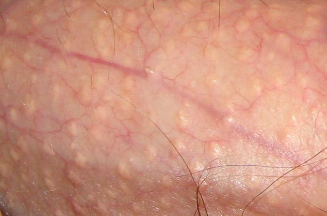 Penile papules on shaft