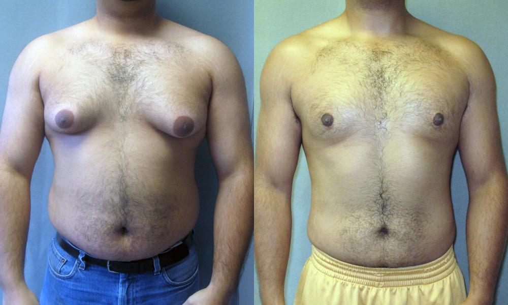 a before and after man boob pic.