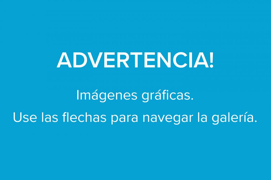 Úlceras bucales: Tipos, causas, síntomas y tratamiento