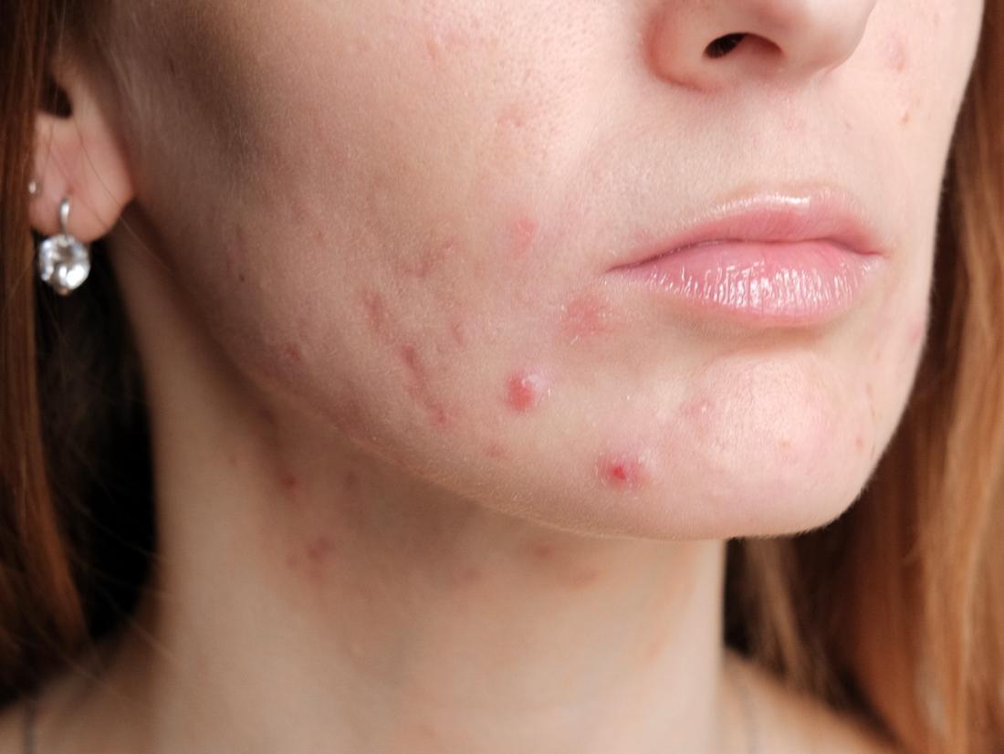 Pregnancy Acne Treatments And Home Remedies