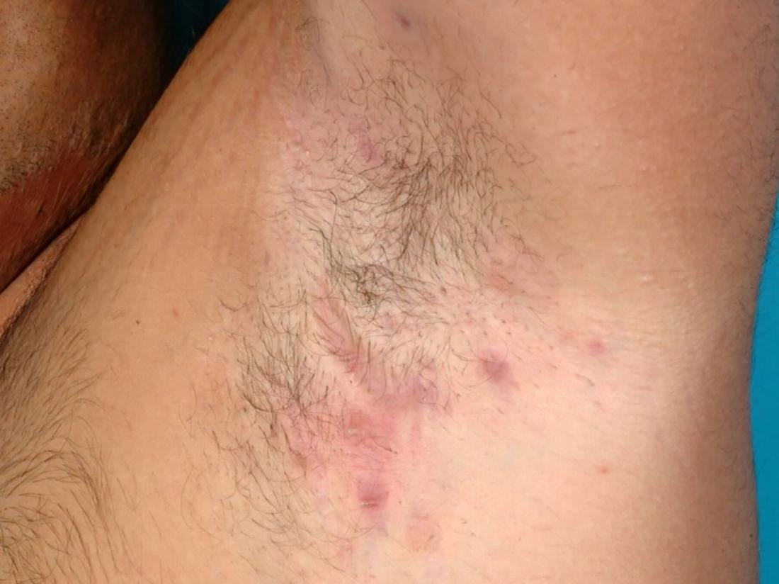 minor hidradenitis suppurativa