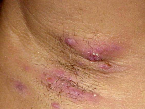 minor hidradenitis suppurativa