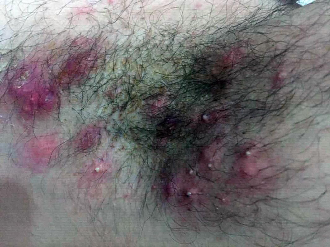 minor hidradenitis suppurativa