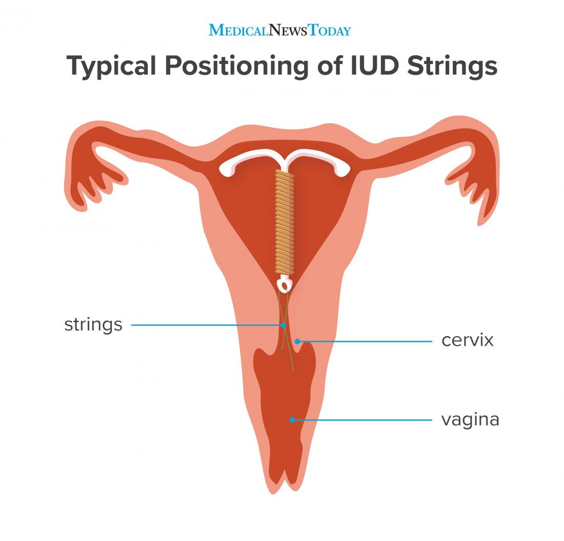 position of IUD strings in the vulva 