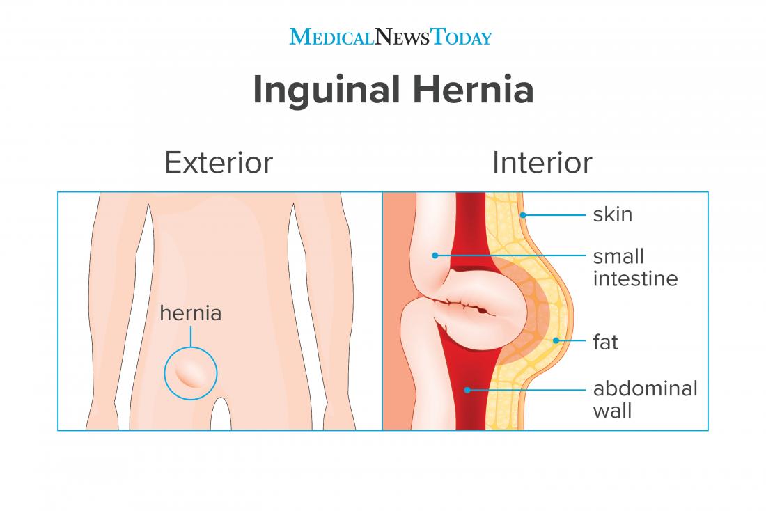 um infográfico de uma hérnia inguinal. 