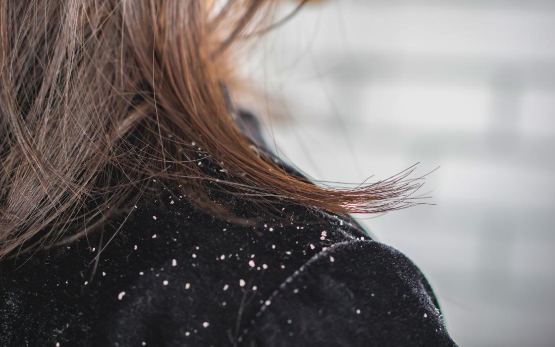 hair with dandruff