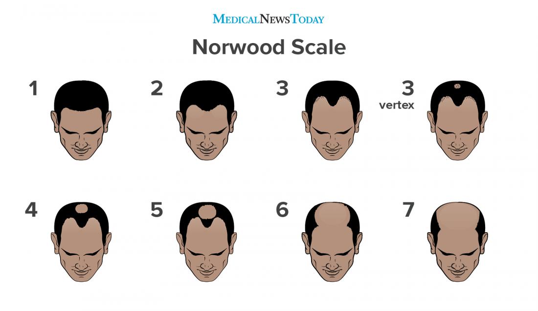 an infographic of the norwood scale. 