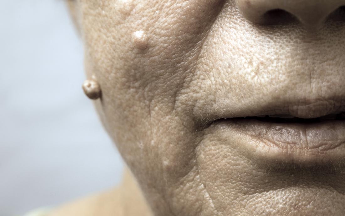 How To Get Rid Of Warts On The Face 