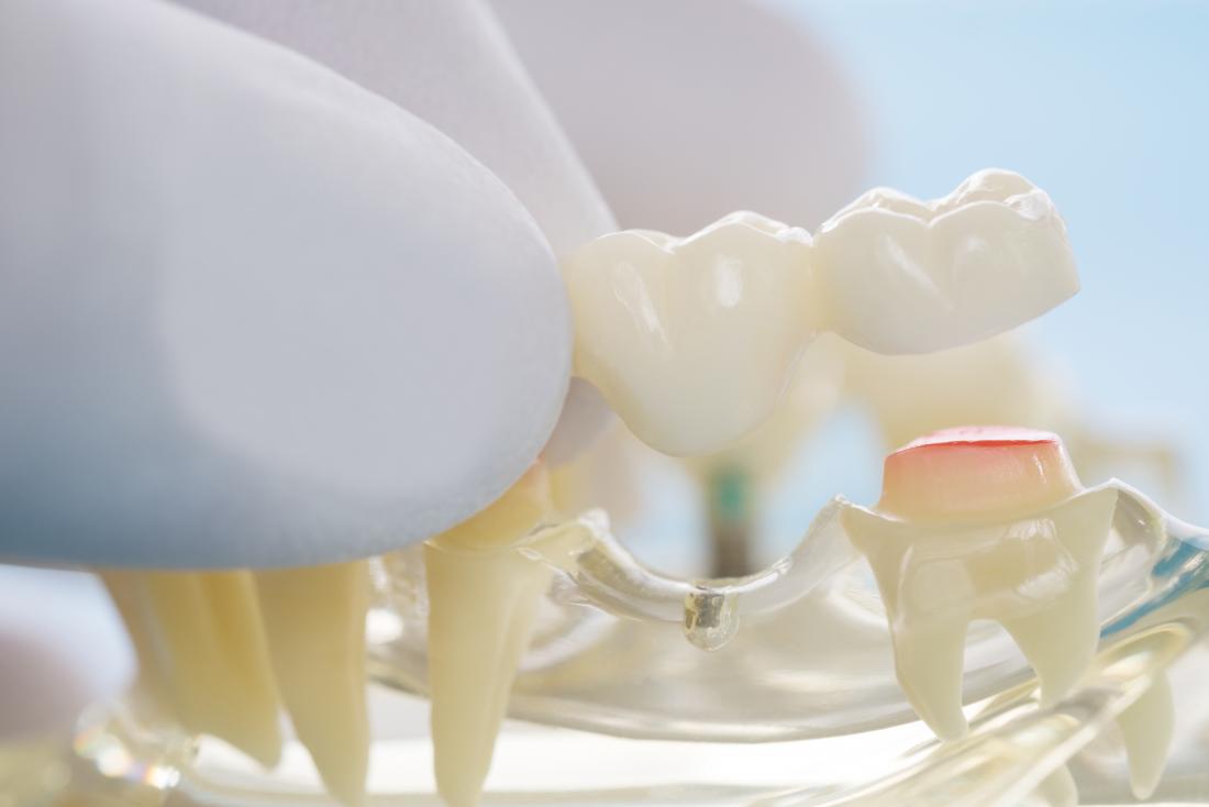 Dental bridge: Uses, types, recovery, and more