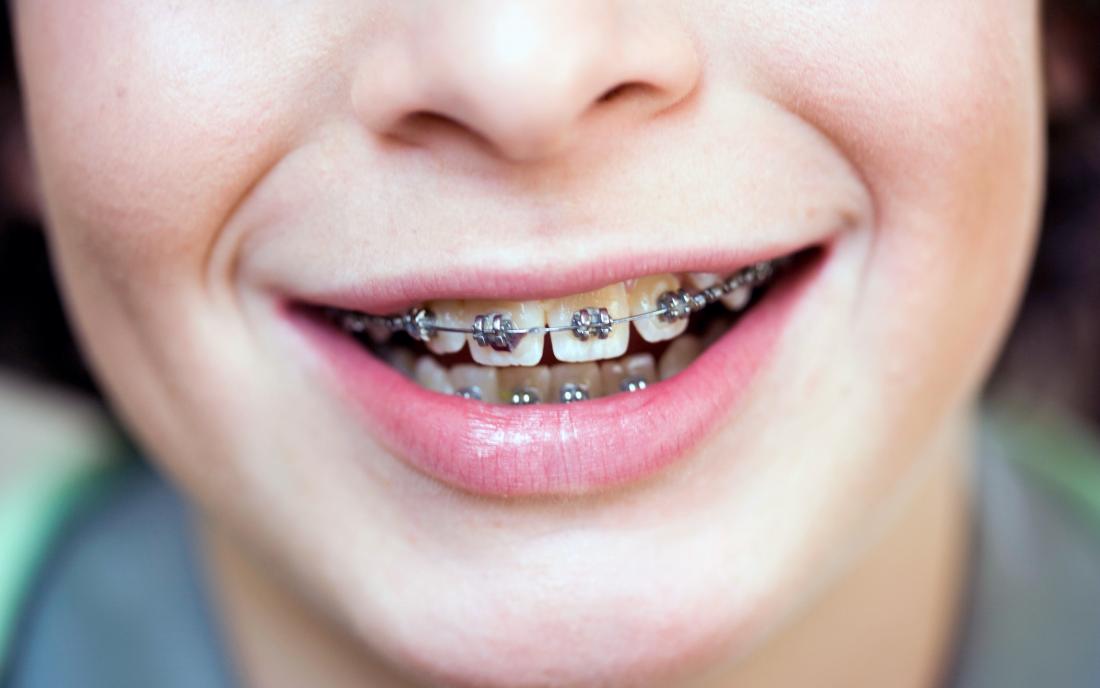 How Nickel, Copper, and Cobalt are Changing Braces - Massih Orthodontics