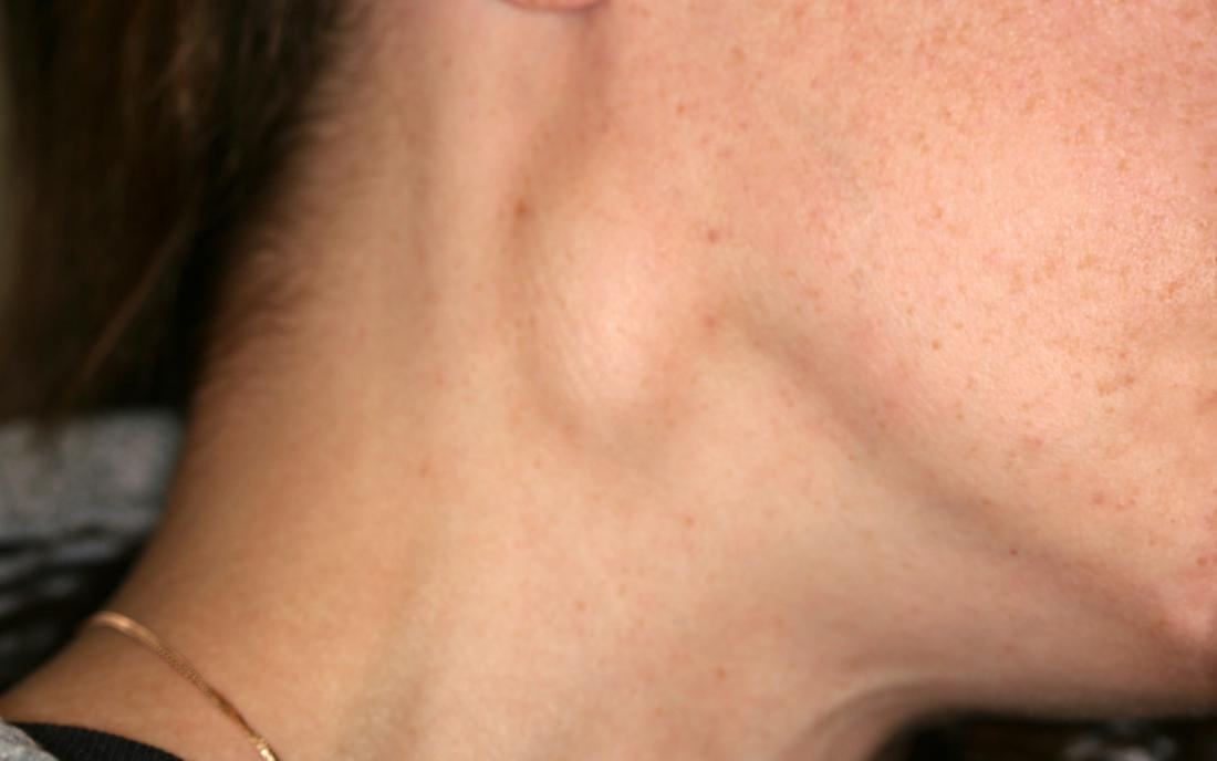 swollen supraclavicular lymph nodes due to infection