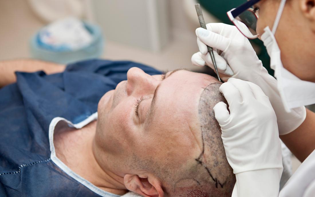 Combination Medical Therapy and Hair Transplant Surgery - Hair Transplant  Case Study - McGrath Medical