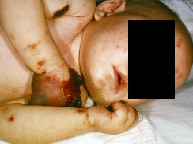 4-month old female with gangrene of her hands due to an infection known as meningococcemia. Image credit: CDC/ Mr. Gust, 1965.