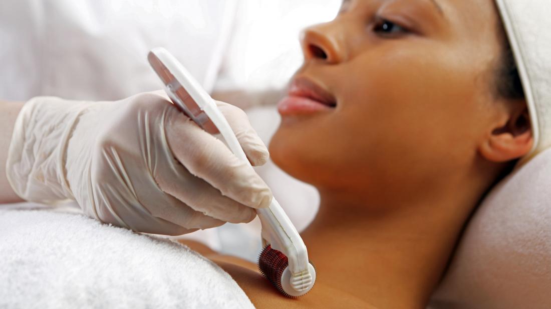 Microneedling with PRP: Benefits, side effects, and more