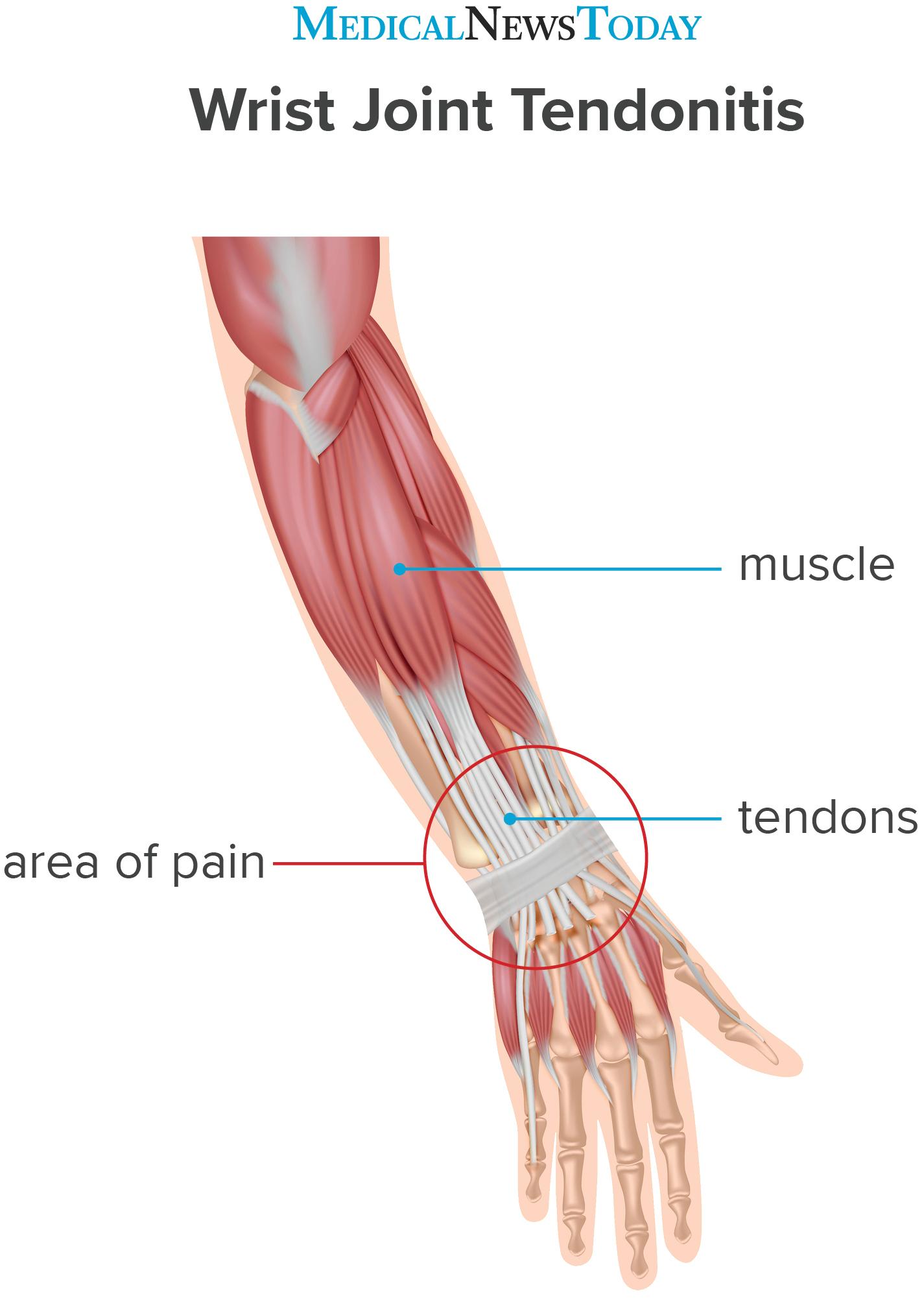 Wrist tendonitis: Treatment, symptoms, causes, and more