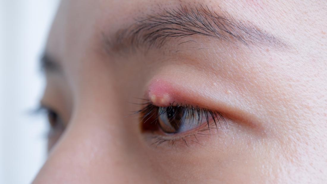 7 ways to treat or get rid of a stye